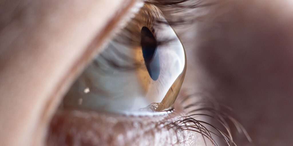 O ceratocone é uma alteração na córnea, parte frontal transparente do olho, que começa a projetar-se para fora como um cone. 